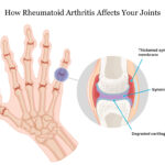 JAK inhibitors are highly effective for Rheumatoid Arthritis: Study | Credits: Google