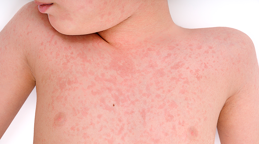 Rashes due to Measles