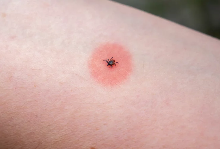 Rash caused because of tick-bite | Credits: Getty Images
