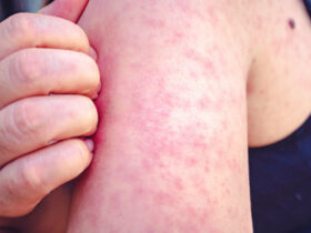 Rashes caused because of measles infection | Credits: iStock