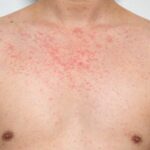 Representation for rashes caused by Measles | Credits: Getty Images