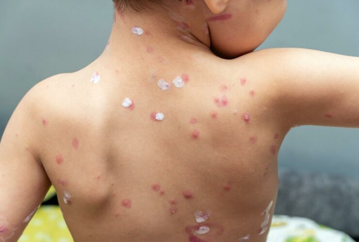 Representation for rashes caused because of Measles