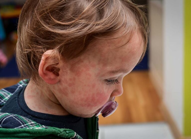 Concerns Surge as Measles Cases Skyrocket Globally, Major Surge Seen in the US